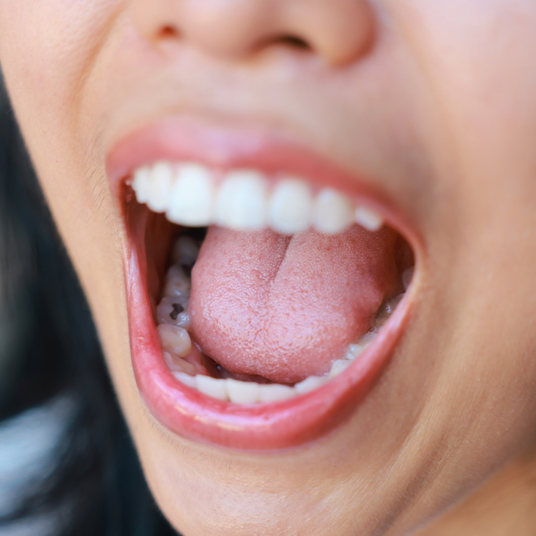 Understanding Dental Fillings: What You Need to Know