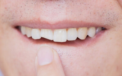 Can A Broken Or Chipped Tooth Be Saved, And What Are The Treatment Options?