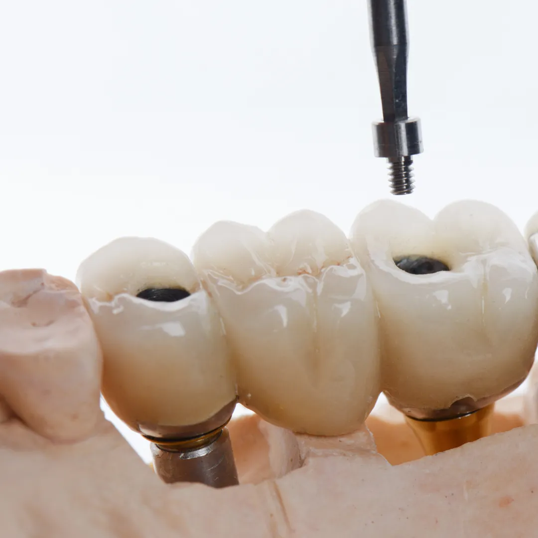 Implant Bridges