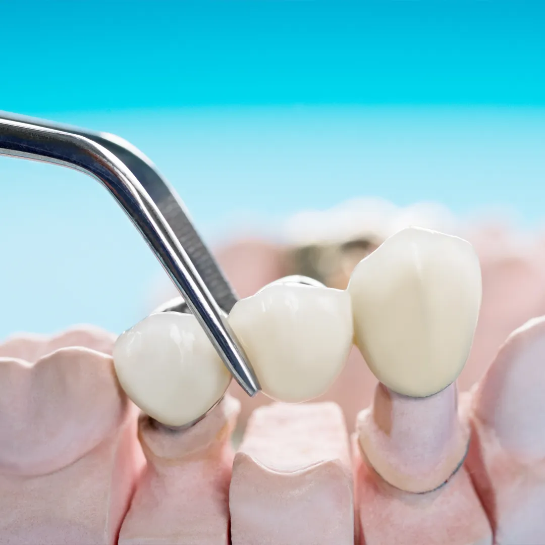 What is a Dental Bridge?