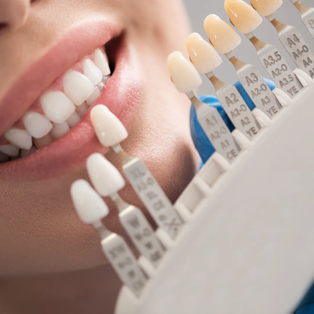 What is a Dental Crown?