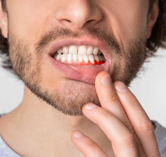 When is Wisdom Tooth Extraction necessary?