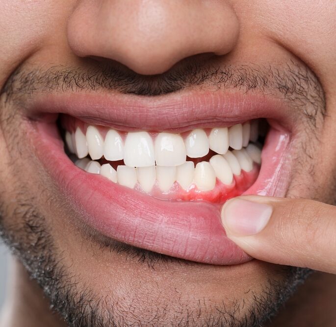 When is Wisdom Tooth Extraction necessary?