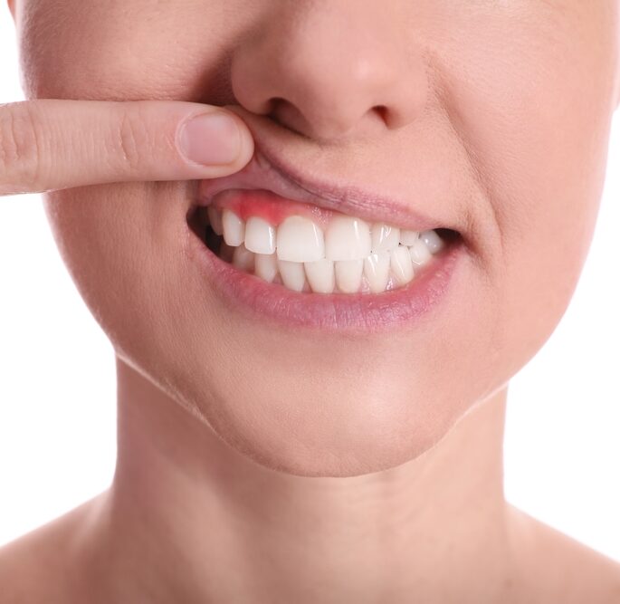 The Importance of Addressing Cavities Promptly