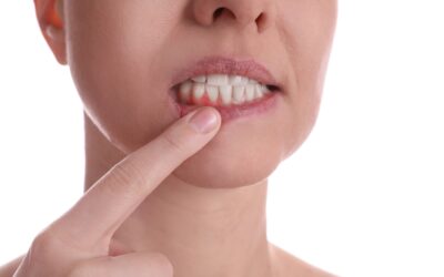 What Causes Sudden Gum Bleeding Without Brushing?